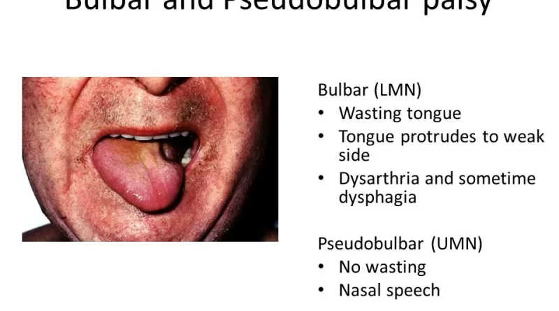 pseudobulbar palsy physiotherapy treatment Archives - SAMARPAN ...