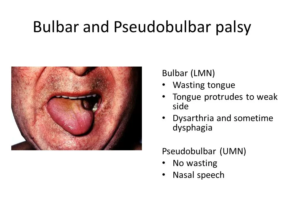 Pseudobulbar Palsy - Cause, Symptoms, Treatment - Samarpan