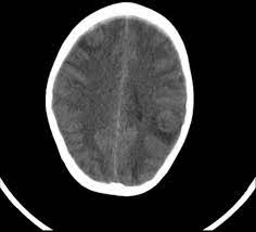 Space occupying lesions of the Brain