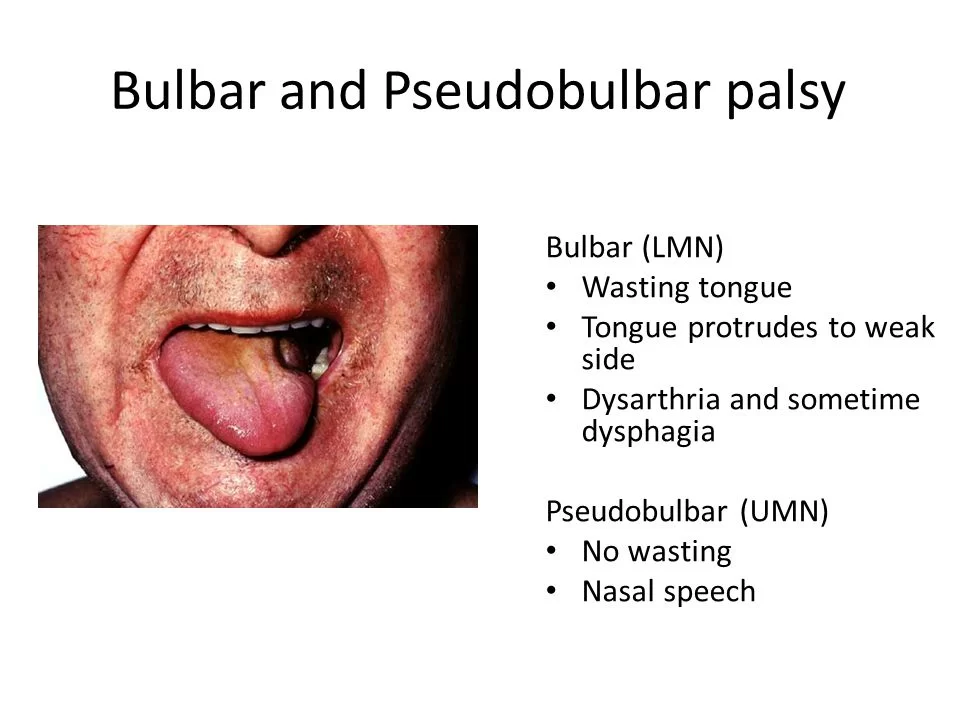 Bulbar palsy