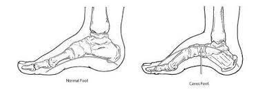 Clubfoot (Congenital talipes equino Varus) - Samarpan Physio