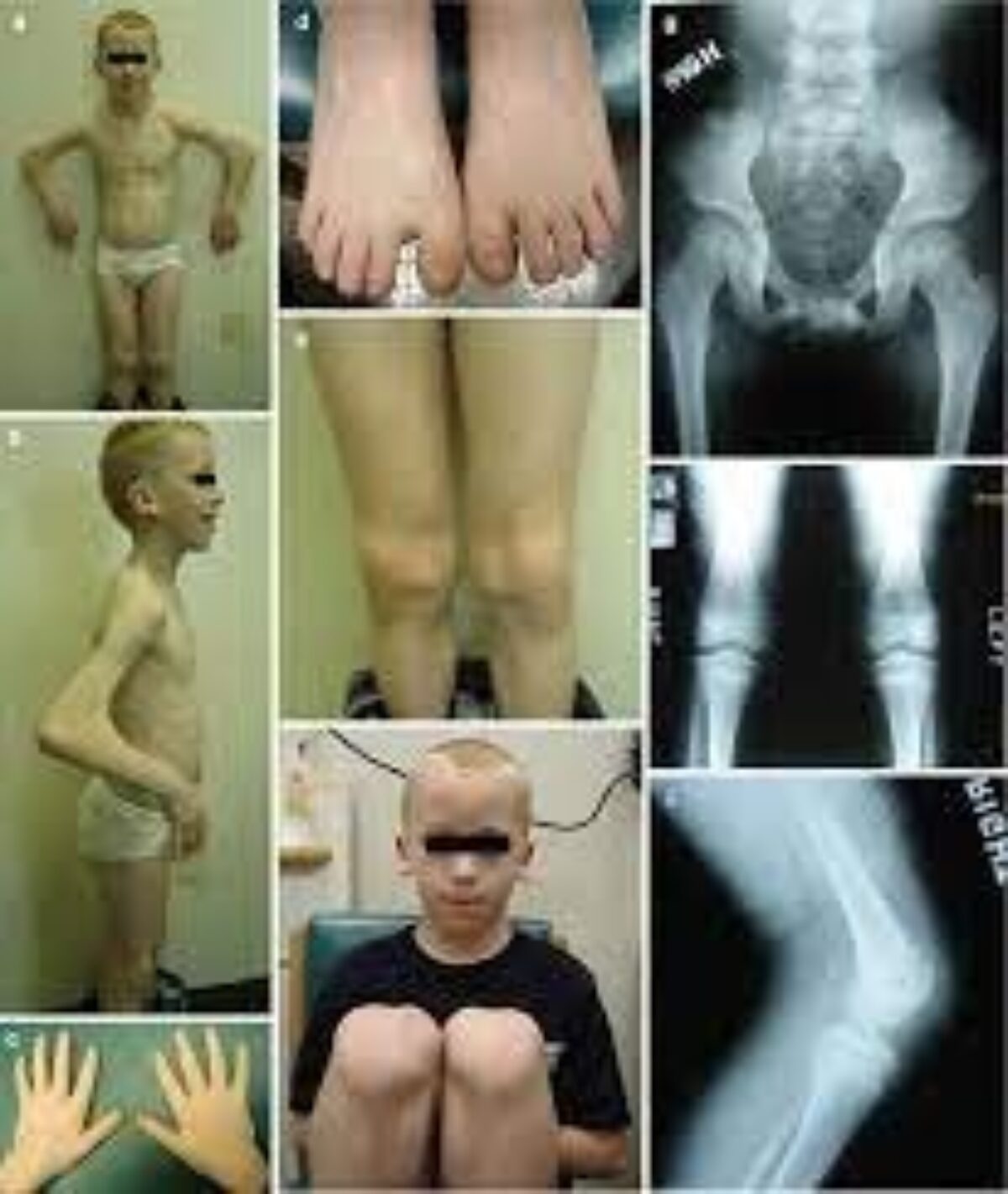 Nail-Patella Syndrome - DoveMed
