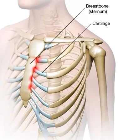 what causes tietze syndrome Archives - SAMARPAN PHYSIOTHERAPY CLINIC ...