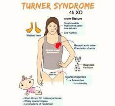 monosomy turner syndrome