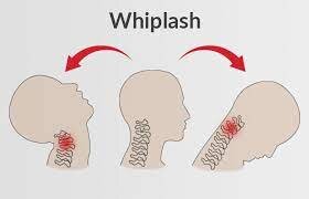 lower back whiplash symptoms Archives - Samarpan Physiotherapy Clinic