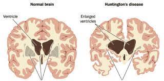 Huntington-Disease