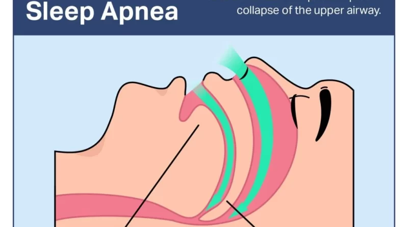 obstructive sleep apnea symptoms Archives - SAMARPAN PHYSIOTHERAPY ...