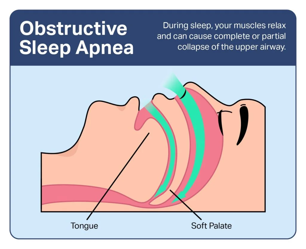 Sleep Apnea Treatment Options: Restore Your Energy