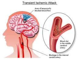 Transient Ischaemic Attack