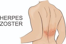 herpes zoster