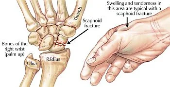 scaphoid-fracture-