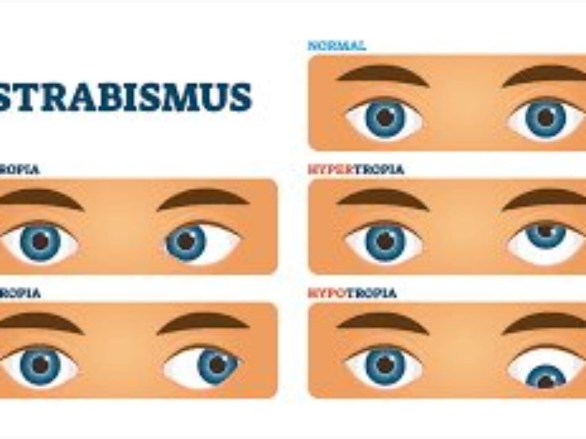 Strabismus  A Patient Guide to Misalignments of the Eyes 