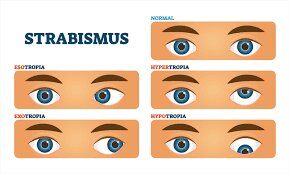 Strabismus (Crossed Eyes)