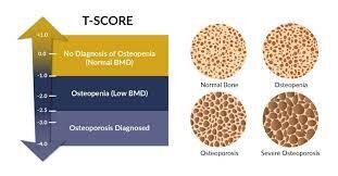 T-score