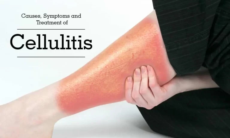 Cellulitis