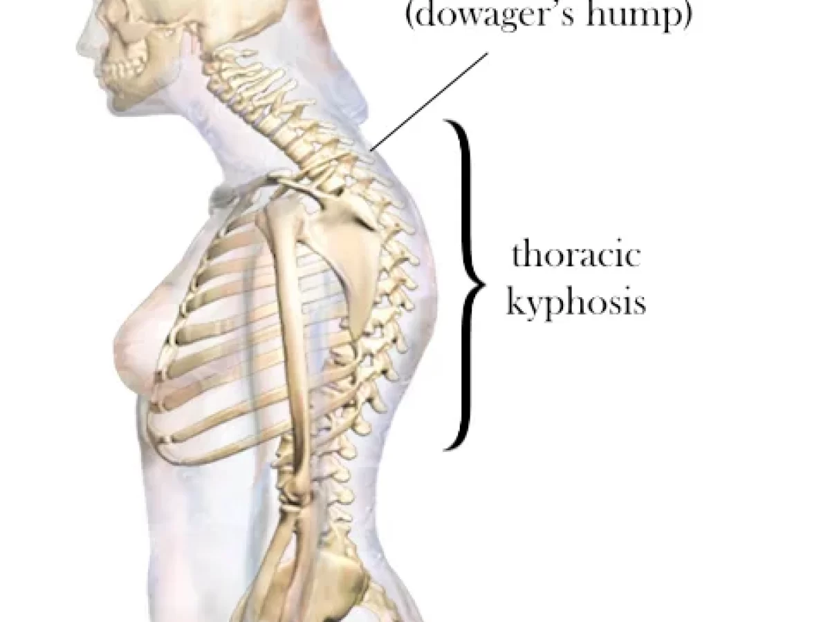 Dowager's Hump: Causes, Symptoms, and Treatment