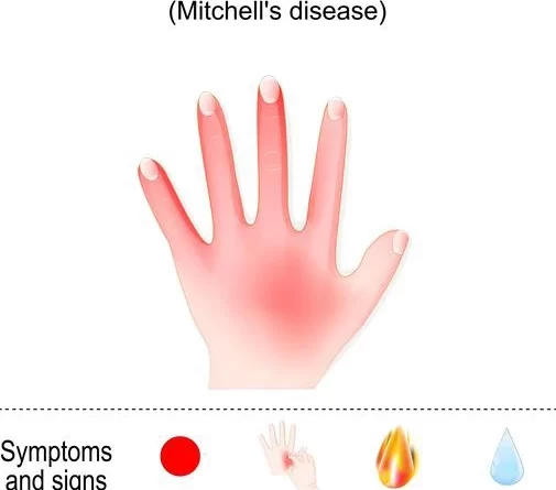 erythromelalgia treatment Archives - SAMARPAN PHYSIOTHERAPY CLINIC ...