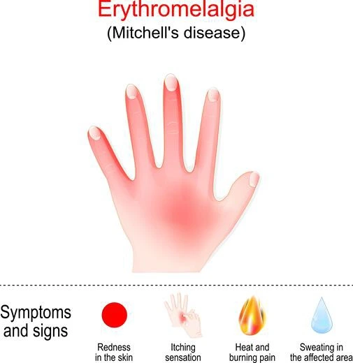 Erythromelalgia