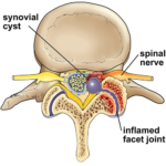 Intraspinal Synovial Cyst - Cause, Symptoms, Treatment, Exercise