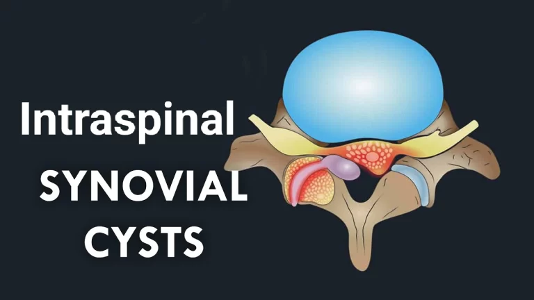 Intraspinal synovial cyst