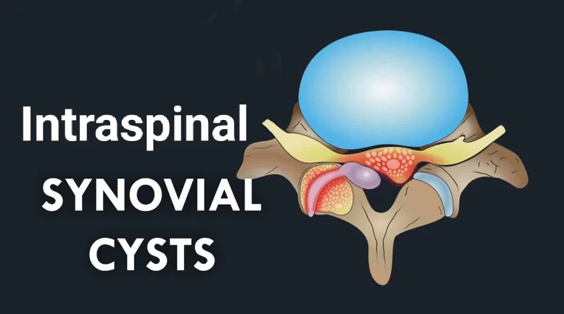 synovial cyst spine treatment Archives - SAMARPAN PHYSIOTHERAPY CLINIC ...