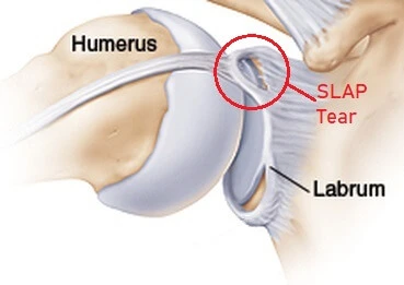 Superior labrum on sale