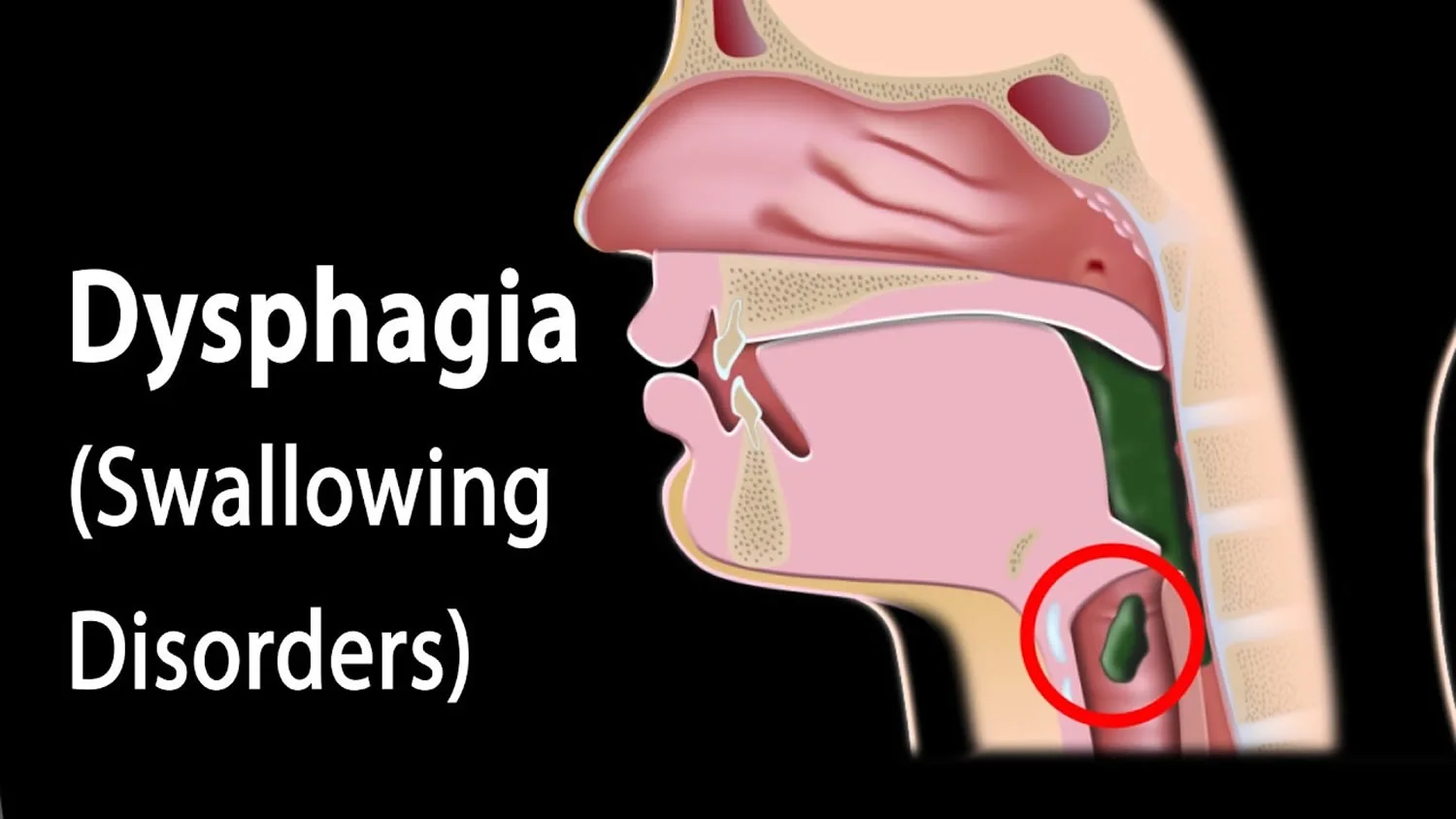 causes of dysphagia