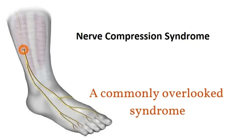 spinal-nerve-compression-syndromes-archives-samarpan-physiotherapy