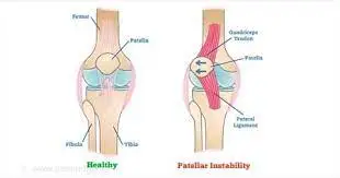 Patellar-instability