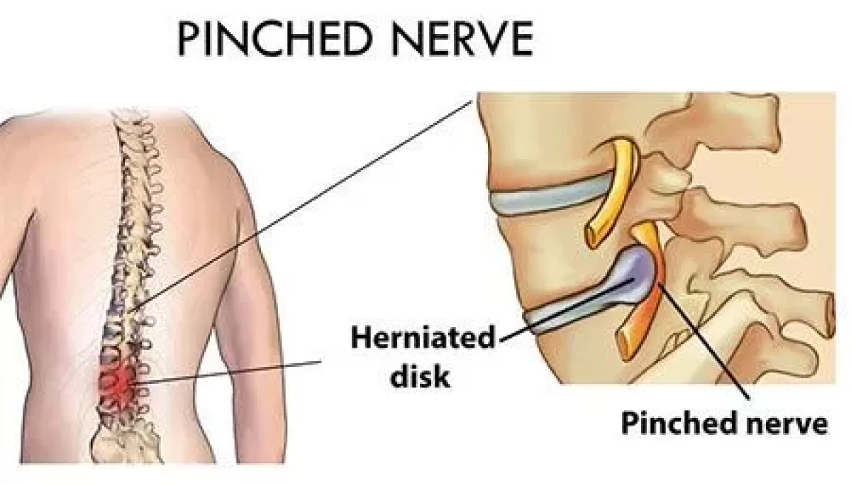 A pinched nerve in the low back - Cause, Symptom, Treatment