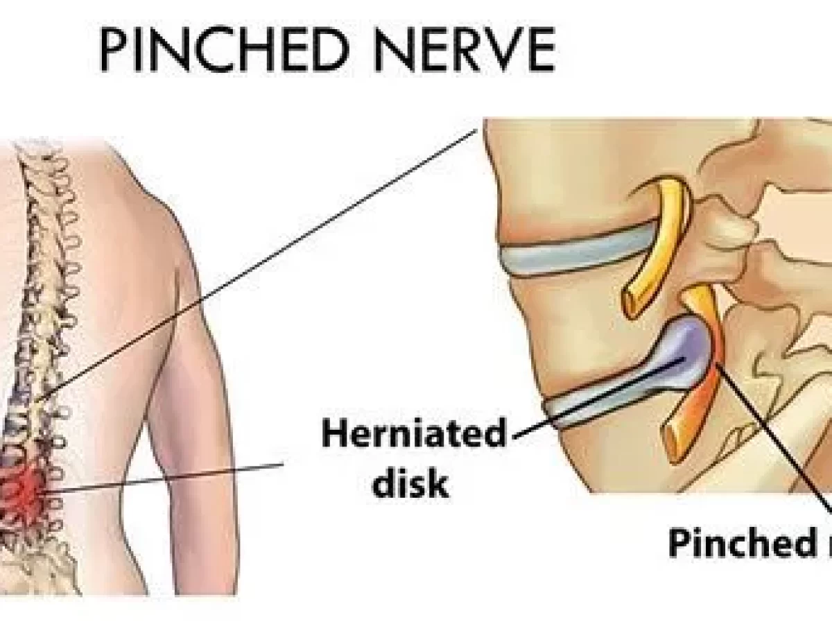 Having a Pinched Nerve in Your Lower Back