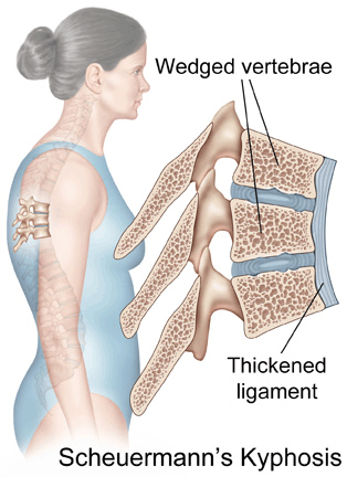 scheuermann disease