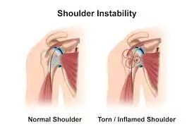 shoulder instability