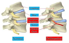 Spinal subluxation