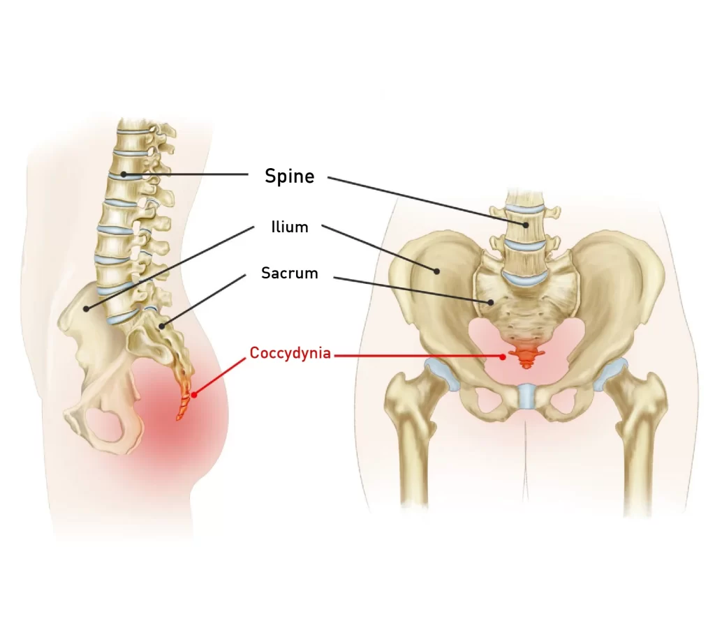 Coccydynia