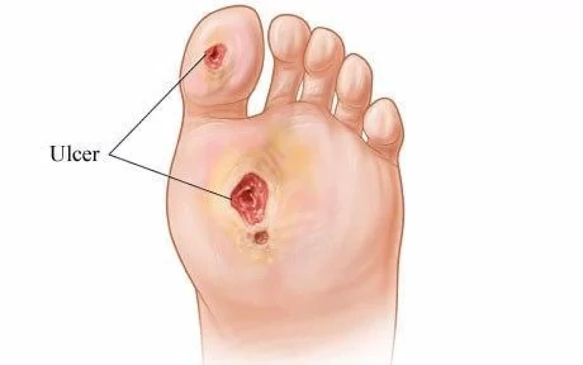 How to Prevent and Treat Diabetic Foot Ulcers - MVS Podiatry Associates