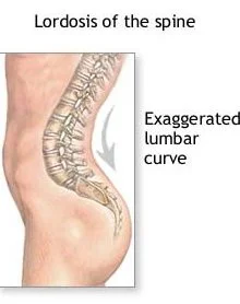 Excessive Lumbar Lordosis