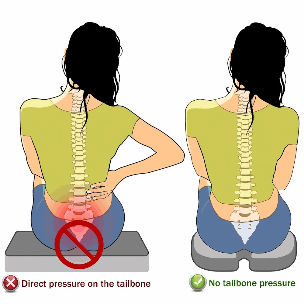 Fractured Coccyx