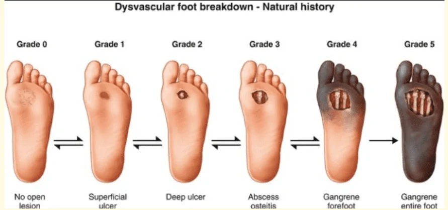 Diabetic Foot Ulcer - Cause, Diagnosis, Treatment, Prognosis