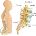 Inter-vertebral Disc Herniation