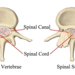 Lumbar Spinal Stenosis