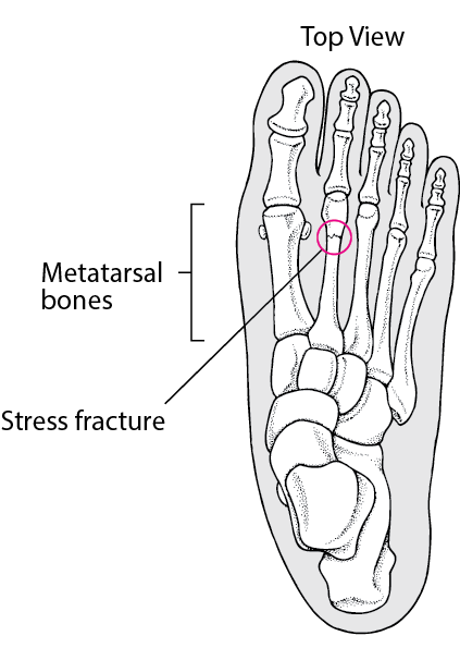 Fractures of the Metatarsal Bones