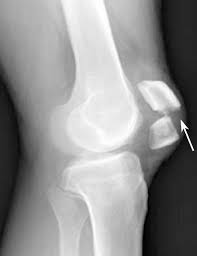 Patellar Fractures - Type, Symptom, Treatment - Samarpan Physio