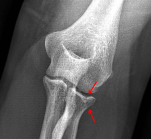 Proximal Radial Head Fracture - Cause, Symptoms, Treatment