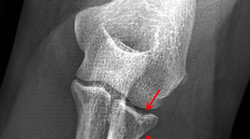 proximal-radial-head-fracture-cause-symptoms-treatment