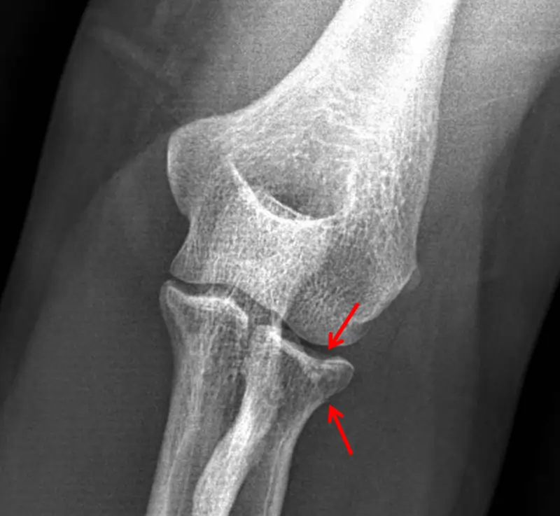 Proximal Radial Head Fracture