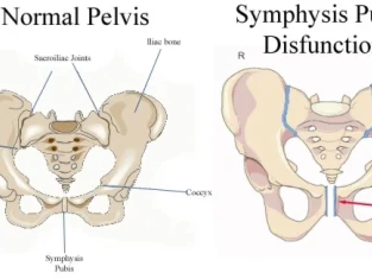Symphysis Pubis Dysfunction (SPD) - Symptoms, Causes & Training Tips