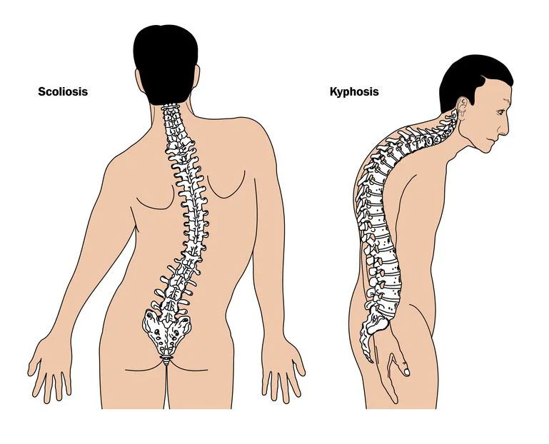 Thoracic Kyphosis