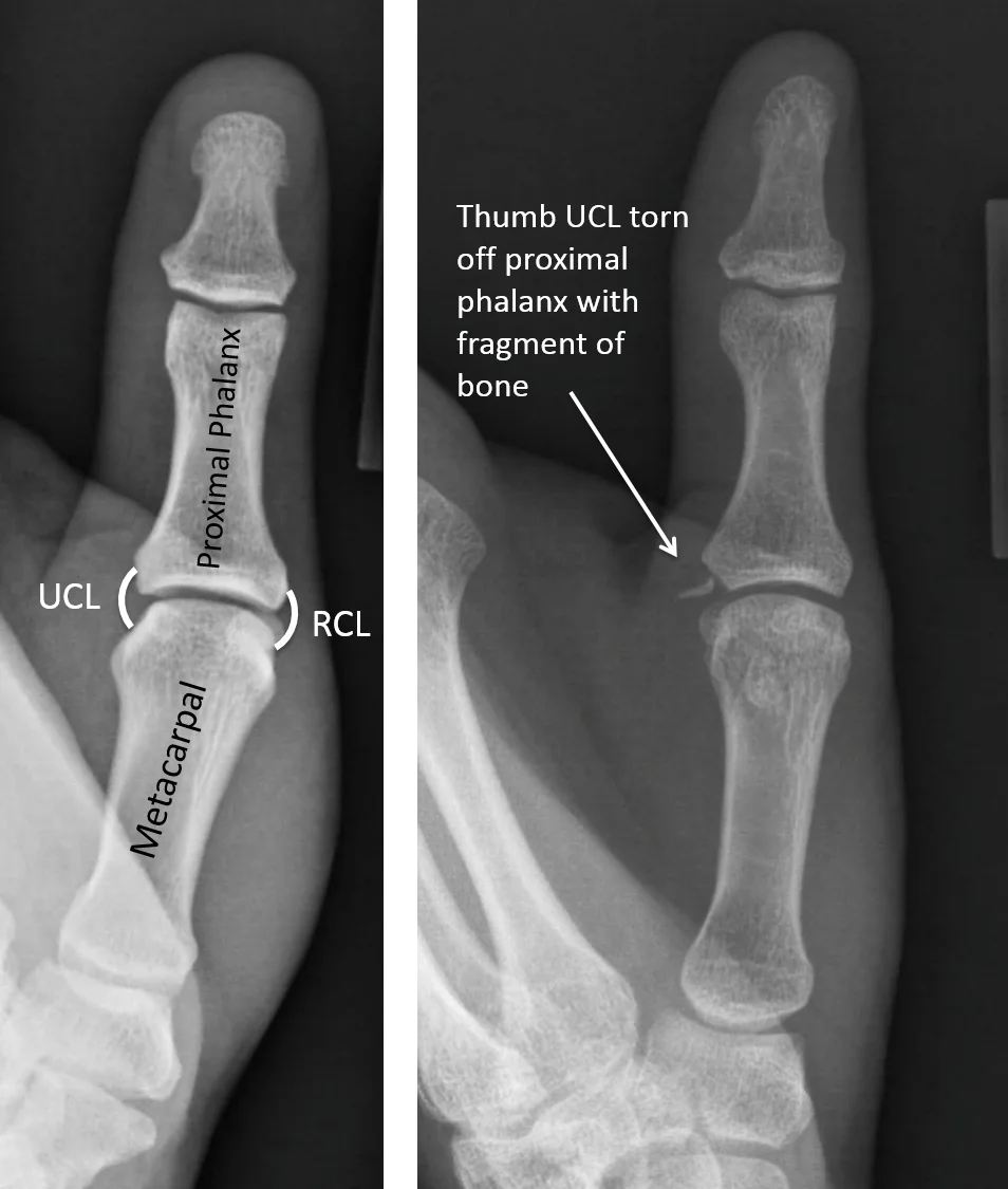 thumb-collateral-ligament-injury-symptoms-treatment