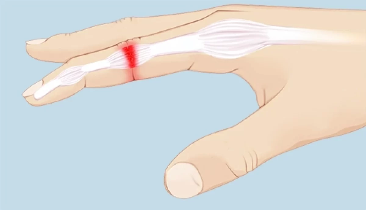 How To Tape Fingers - Support Taping for Finger Sprains & Injuries